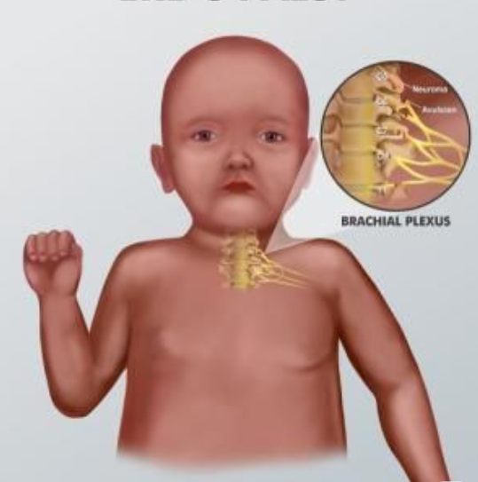 Birth Injuries / Erb's Palsy